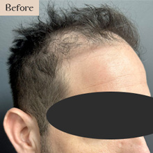 fue hair transplant white plains before treatment image
